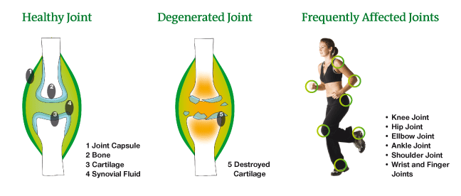 Osteoarthritis – an endemic disease